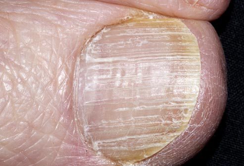 Knowing Facts about Yellow Cracked Toenails - Healthy Tips